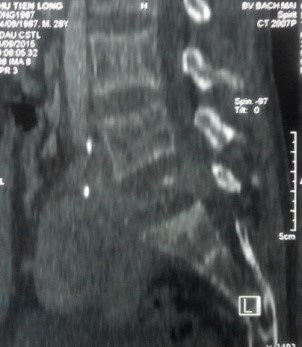 CT scanner: khối u phá hủy thân đốt L5