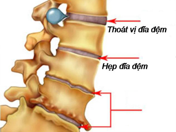 Thoát vị địa đệm là một nguyên nhân của đau thắt lưng