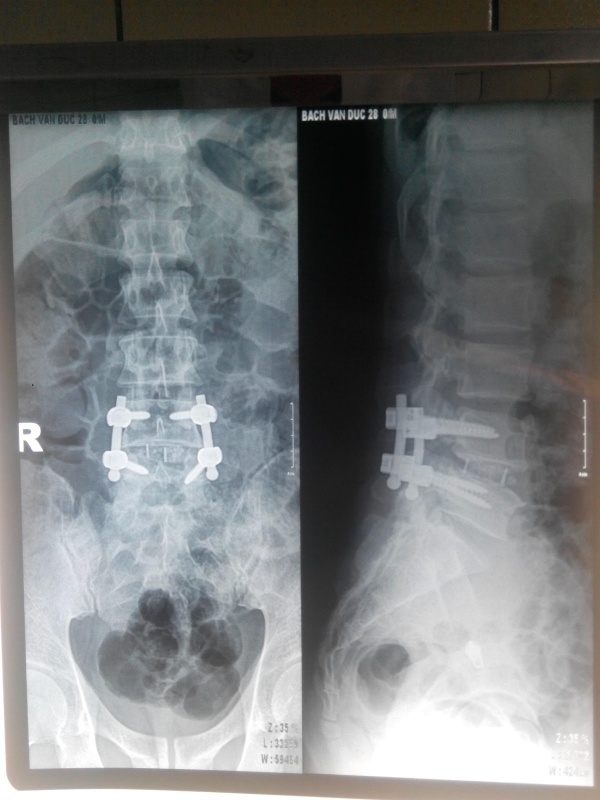 Hình 3: X-quang sau mổ (BN Bạch Văn Đ)