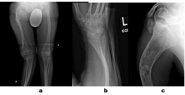 Hình 2: Hình ảnh Xquang các biến dạng (a) chi dưới, (b) xương cẳng tay (c) xương cánh tay. Đó là các biến dạng gập góc, thành xương mỏng, mật độ xương thấp