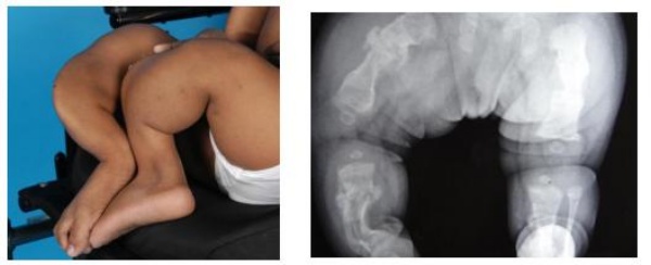 Hình 1: Trẻ 16 tuổi bị bệnh xương bất toàn biến dạng chi dưới không thể đi lại được