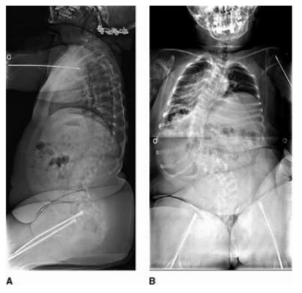 Hình 4: Hình ảnh Xquang trẻ gái 16 tuổi, bệnh xương bất toàn có vẹo cột sống ngực