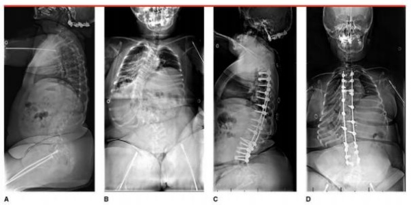 Hình 6: (A, B) Hình ảnh Xquang cột sống trẻ 16 tuổi bị vẹo cột sống ngực và thắt lưng do IO. (C, D): Hình ảnh Xquang cột sống sua mổ chỉnh vẹo 2 năm thấy vẹo tiến triển đoạn thắt lưng dưỡi vị trí bắt vít.