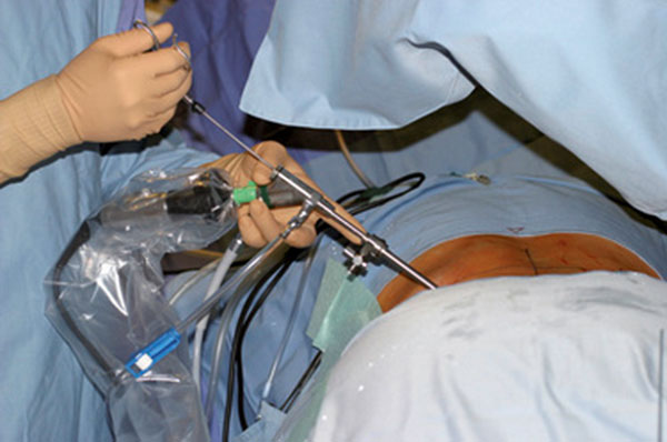 Phẫu thuật nội soi lấy thoát vị đĩa đệm cột sống thắt lưng qua lỗ liên hợp