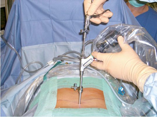 Phẫu thuật nội soi lấy thoát vị đĩa đệm cột sống thắt lưng qua liên bản sống