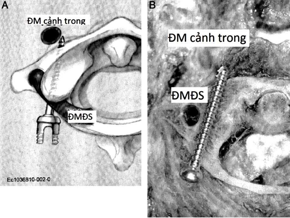 Hình ảnh minh họa (A) và trên tử thi (B) mô tả tương quan ĐM cảnh trong, ĐMĐS và vít trong phẫu thuật vít khối bên C1