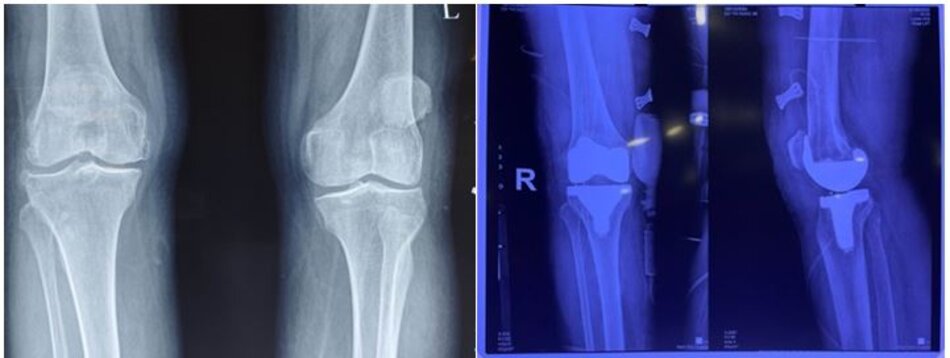 X-quang trước mổ và sau mổ bệnh nhân thay khớp gối toàn phần do thoái hoá