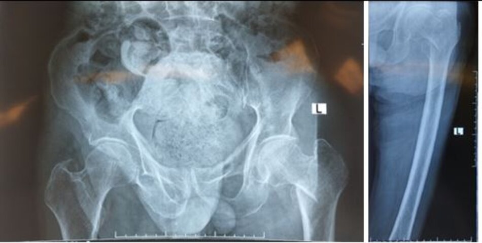 Xquang trước mổBệnh nhân nữ, 87t, Gãy liên mấu chuyển xương đùi trái, phẫu thuật thay khớp háng bán phần chuôi dài.
