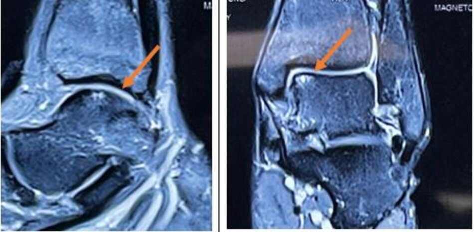Hình ảnh tổn thương viêm xương sụn lóc tách xương sên trên phim chụp MRI
