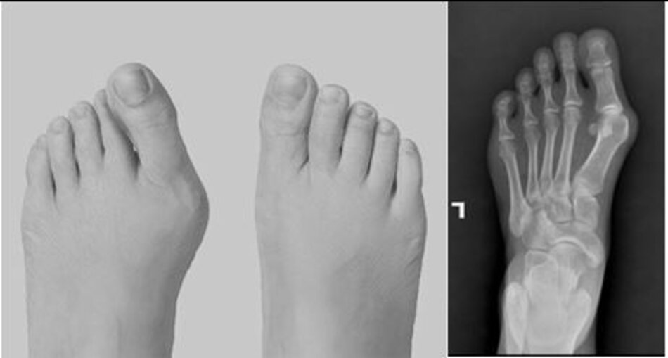 Hình ảnh bàn chân trái và X-quang bàn chân trước mổ