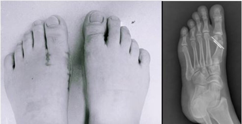 Hình ảnh bàn chân trái và X-quang bàn chân sau chỉnh hình vẹo ngón