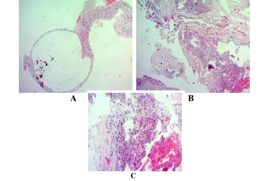 Hình ảnh mô bệnh học khối u sau mổ trên tiêu bản nhuộm Hematoxylin-Eosin