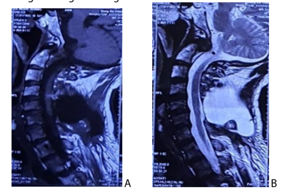 MRI cột sông cổ sau mổ lần đầu 2 năm 