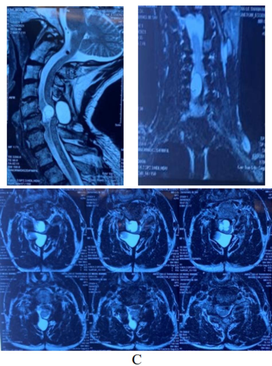 MRI cột sống cổ thời điểm phẫu thuật lần 2 (Khối u dạng nang lệch phải trong ống sống đè đẩy tủy ngang C5-C6)